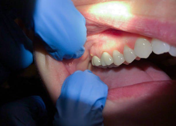 Best Emergency Broken Tooth Repair in Palmyra, NJ